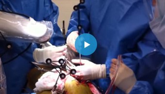 Total Hip Replacement using MAKO Robotic Assistance