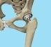 Techniques of Minimally Invasive Hip Surgery